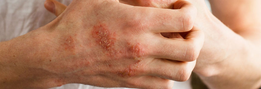 Eczema chronique de la main